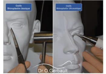 La rhinoplastie ultrasonique, invention du Dr Olivier Gerbault de Paris